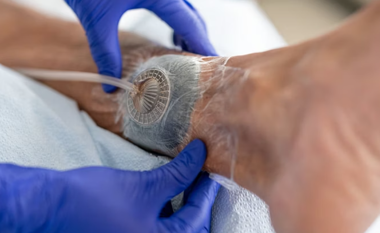 Negative pressure wound therapy